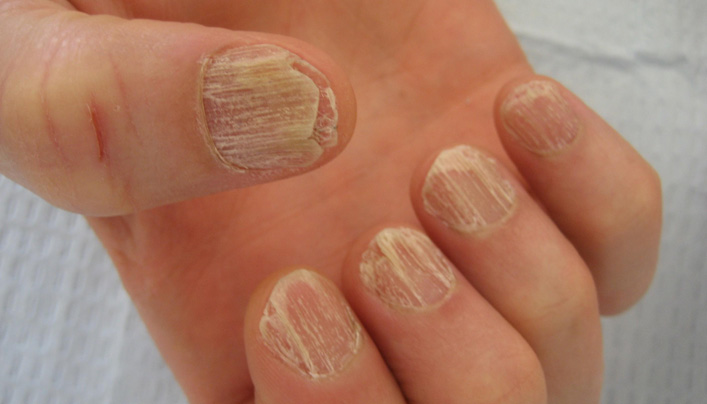 Bạn có đang sở hữu dấu hiệu đặc trưng ở người bị thiếu chất sắt này không? - Ảnh 2. Bạn có đang sở hữu dấu hiệu đặc trưng ở người bị thiếu chất sắt này không? - Ảnh 2.