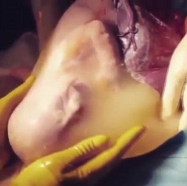Khoảnh khắc bác sĩ rạch bụng mẹ mà em bé vẫn chào đời trong túi nước ối nguyên vẹn - Ảnh 2.