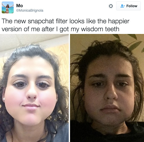 Nở rộ trào lưu khoe ảnh nhổ răng khôn chẳng cần tới hiệu ứng như Snapchat - Ảnh 4.