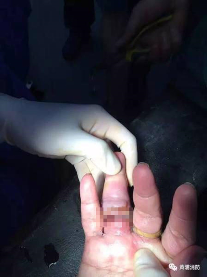 Đeo nhẫn đủ 10 ngón tay, người phụ nữ thích khoe của khóc tu tu gọi đội cứu hộ vì không tháo ra được - Ảnh 3. Đeo nhẫn đủ 10 ngón tay, người phụ nữ thích khoe của khóc tu tu gọi đội cứu hộ vì không tháo ra được 3