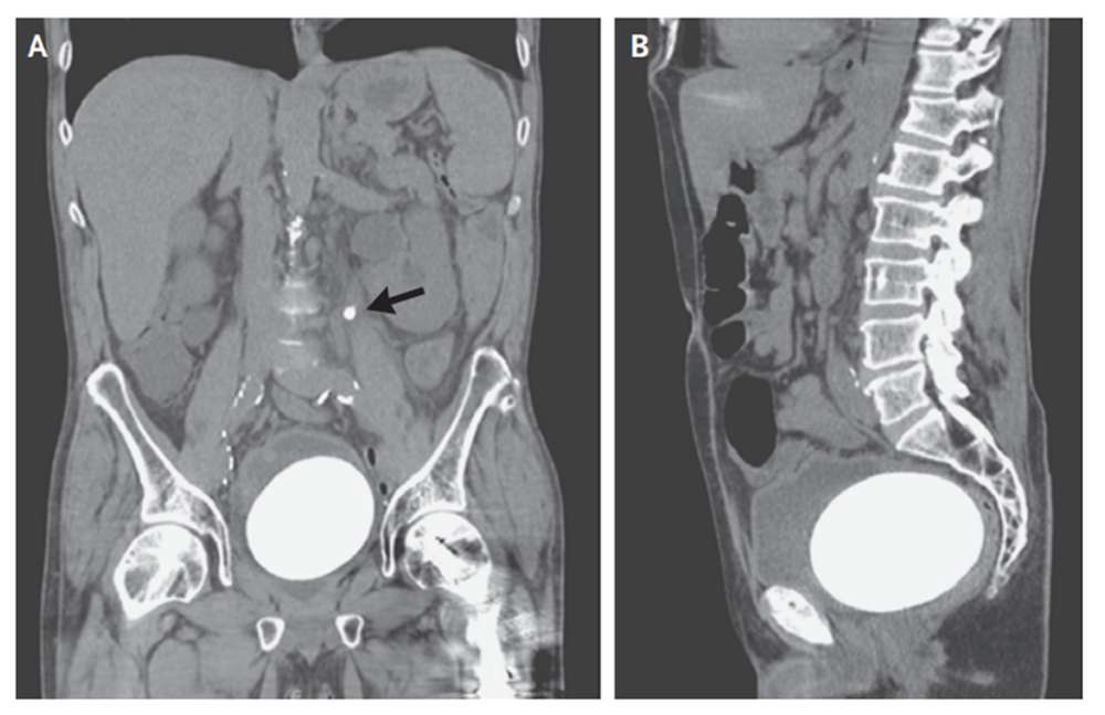 Đau bụng, người đàn ông nhập viện chụp X-quang và thu được một kết quả đáng sợ - Ảnh 1. Đau bụng, người đàn ông nhập viện chụp X-quang và thu được một kết quả đáng sợ - Ảnh 1.