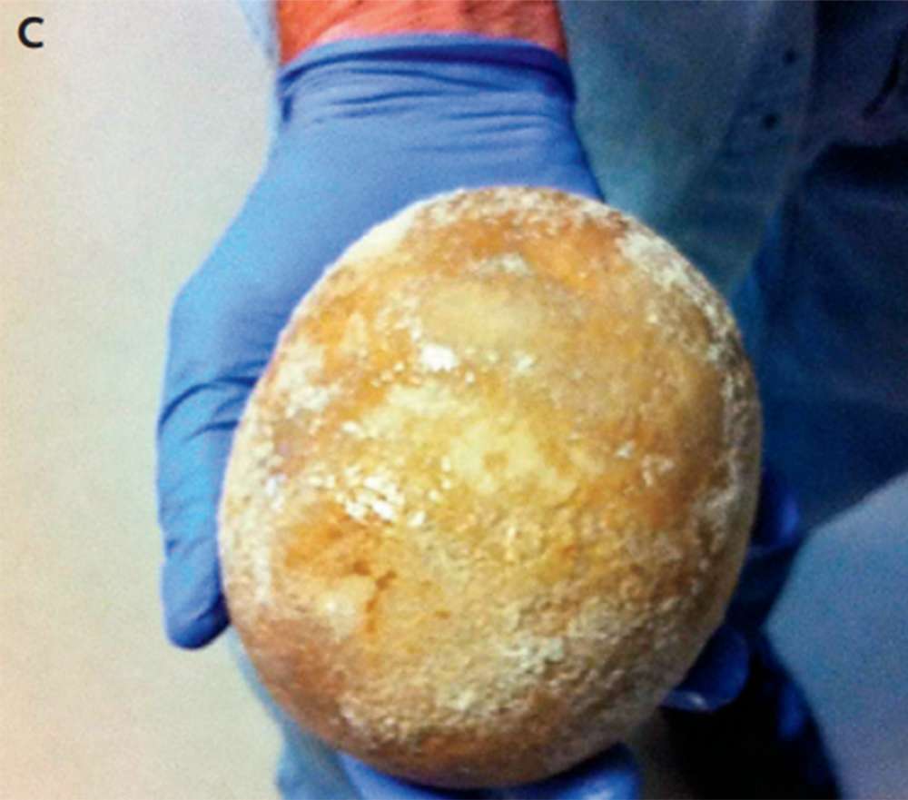 Đau bụng, người đàn ông nhập viện chụp X-quang và thu được một kết quả đáng sợ - Ảnh 2. Đau bụng, người đàn ông nhập viện chụp X-quang và thu được một kết quả đáng sợ - Ảnh 2.