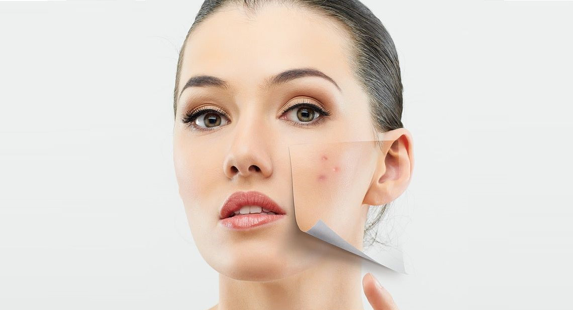 Những suy nghĩ sai lầm khiến việc trị mụn kéo dài đằng đẵng - Ảnh 4. Những suy nghĩ sai lầm khiến việc trị mụn kéo dài đằng đẵng - Ảnh 4.