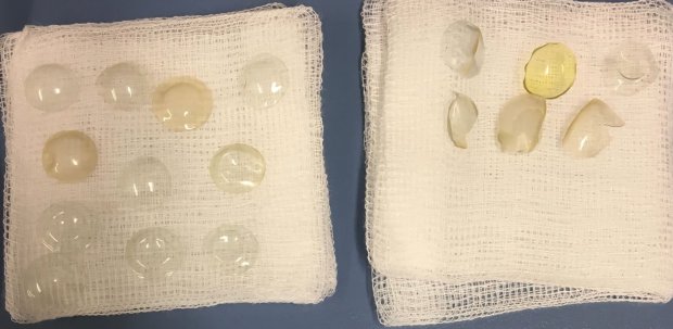 Phẫu thuật đục thủy tinh thể, bác sĩ tá hỏa khi phát hiện trong mắt bệnh nhân có tới 27 kính áp tròng Phẫu thuật đục thủy tinh thể, bác sĩ tá hỏa khi phát hiện trong mắt bệnh nhân có tới 27 kính áp tròng