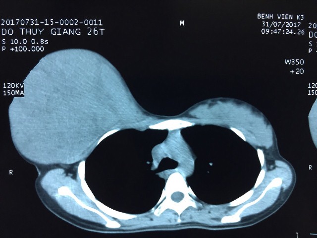 Xúc động người mẹ trì hoãn phẫu thuật khối u tuyến vú khủng để sinh con - Ảnh 1. Xúc động người mẹ trì hoãn phẫu thuật khối u tuyến vú khủng để sinh con - Ảnh 1.