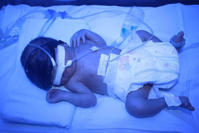 TP.HCM: Cứu sống bé sơ sinh chỉ nặng 1,3kg trong tình trạng suy hô hấp nặng - Ảnh 2. TP.HCM: Cứu sống bé sơ sinh chỉ nặng 1,3kg trong tình trạng suy hô hấp nặng - Ảnh 2.