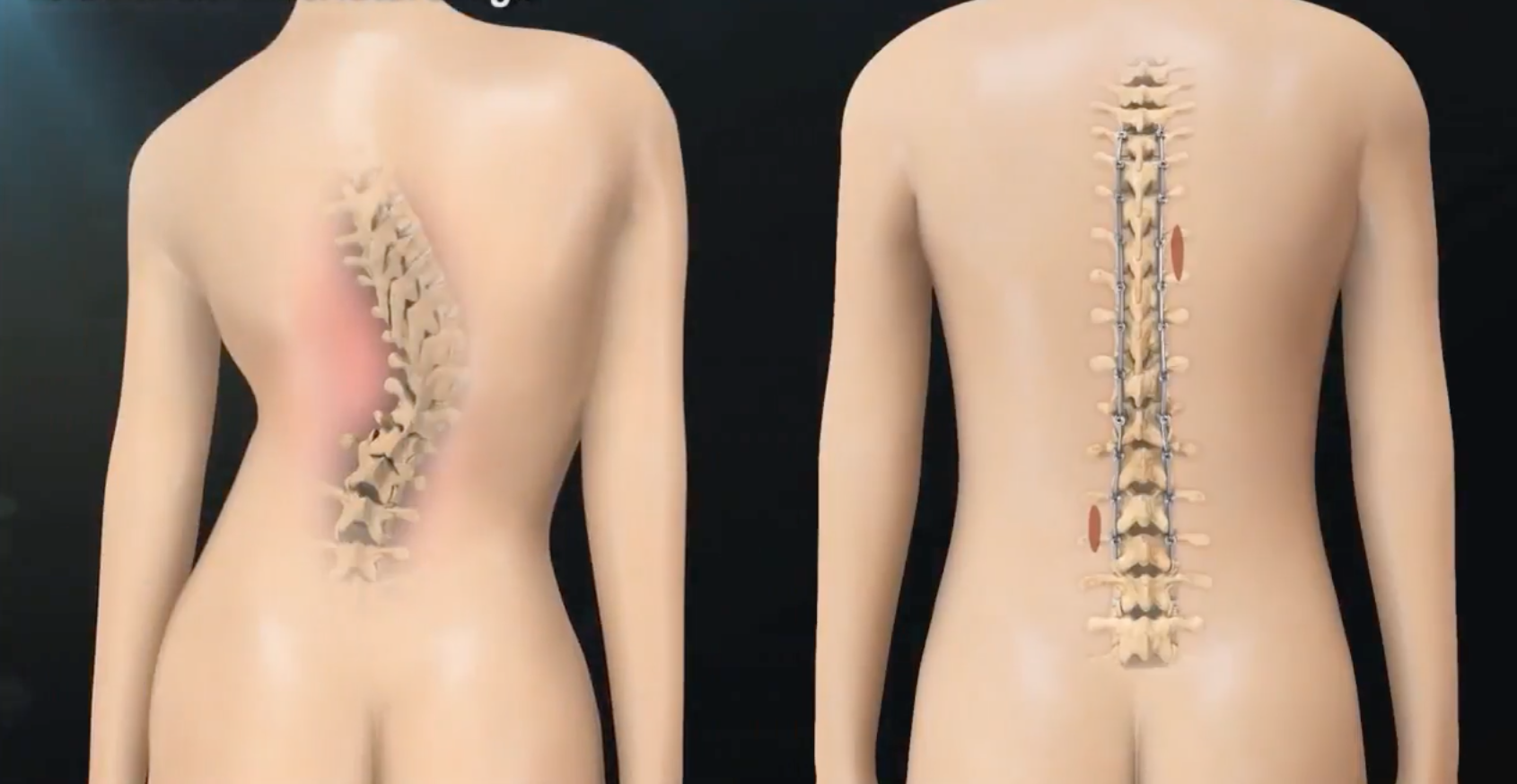 Xem quy trình phẫu thuật nắn cột sống đau nhức nhối khiến bạn chẳng bao giờ dám ngồi sai tư thế nữa - Ảnh 13. Xem quy trình phẫu thuật nắn cột sống đau nhức nhối khiến bạn chẳng bao giờ dám ngồi sai tư thế nữa - Ảnh 13.