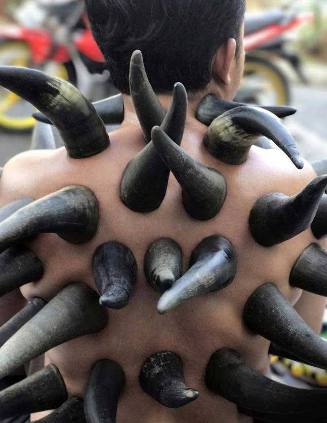 Nhìn hình ảnh này ai cũng rùng mình, nhưng sự thật thì nó là một phương pháp điều trị y học - Ảnh 1. Nhìn hình ảnh này ai cũng rùng mình, nhưng sự thật thì nó là một phương pháp điều trị y học - Ảnh 1.