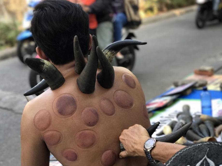 Nhìn hình ảnh này ai cũng rùng mình, nhưng sự thật thì nó là một phương pháp điều trị y học - Ảnh 3. Nhìn hình ảnh này ai cũng rùng mình, nhưng sự thật thì nó là một phương pháp điều trị y học - Ảnh 3.