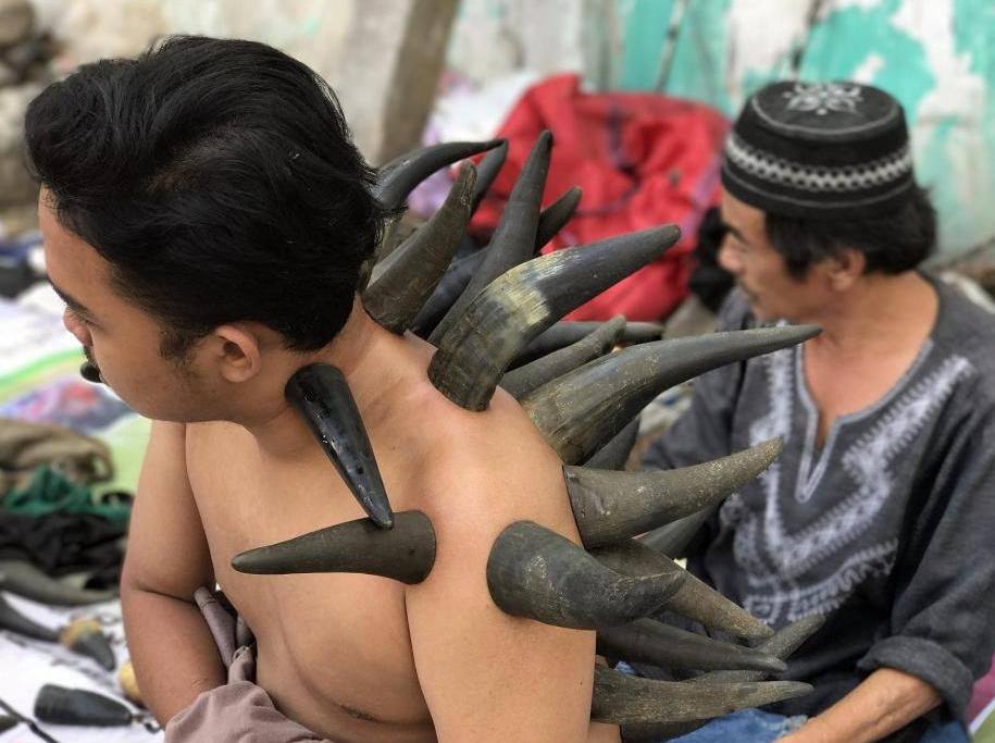 Nhìn hình ảnh này ai cũng rùng mình, nhưng sự thật thì nó là một phương pháp điều trị y học - Ảnh 5. Nhìn hình ảnh này ai cũng rùng mình, nhưng sự thật thì nó là một phương pháp điều trị y học - Ảnh 5.