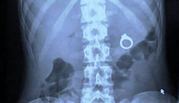 Những tấm phim chụp X-quang kinh dị nhất mà bạn từng thấy: bị mũi khoan, dao sắc hay đinh nhọn xuyên thủng hộp sọ vẫn sống sót - Ảnh 2.