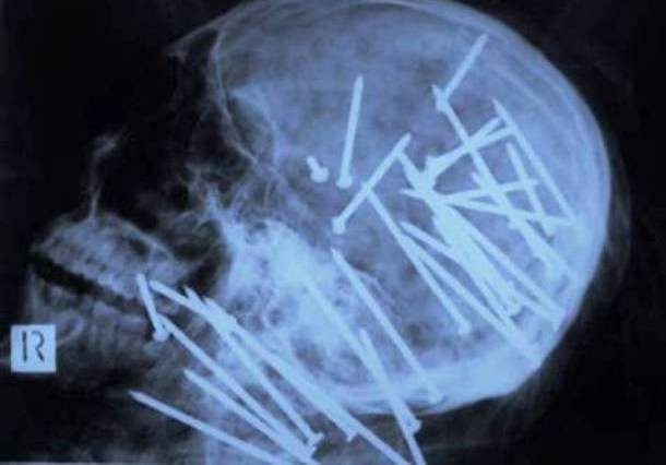 Những tấm phim chụp X-quang kinh dị nhất mà bạn từng thấy: bị mũi khoan, dao sắc hay đinh nhọn xuyên thủng hộp sọ vẫn sống sót - Ảnh 4.