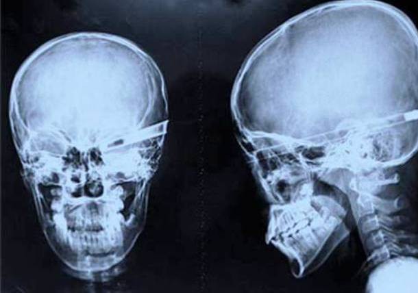 Những tấm phim chụp X-quang kinh dị nhất mà bạn từng thấy: bị mũi khoan, dao sắc hay đinh nhọn xuyên thủng hộp sọ vẫn sống sót - Ảnh 6.