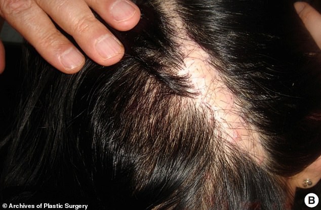 Cô gái 21 tuổi bị bỏng da đầu nghiêm trọng, tóc rụng hói nguyên mảng dài sau khi đi nhuộm tóc về - Ảnh 3.