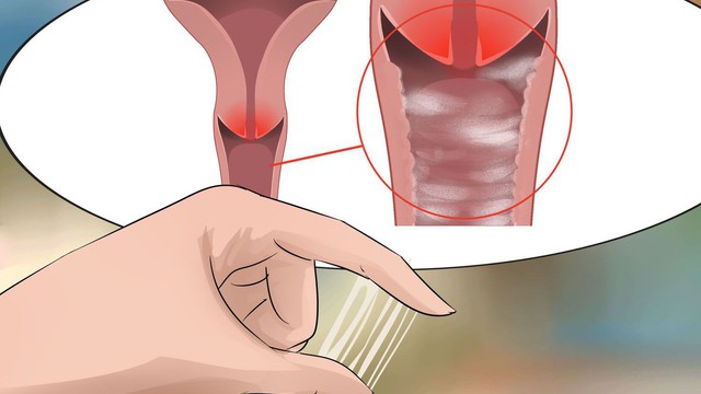 Kết quả hình ảnh cho viêm âm đạo