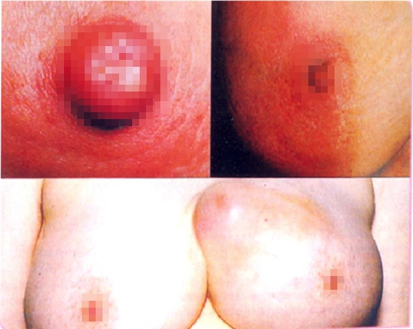 Cận cảnh sự tàn phá của ung thư vú tới bầu ngực 11