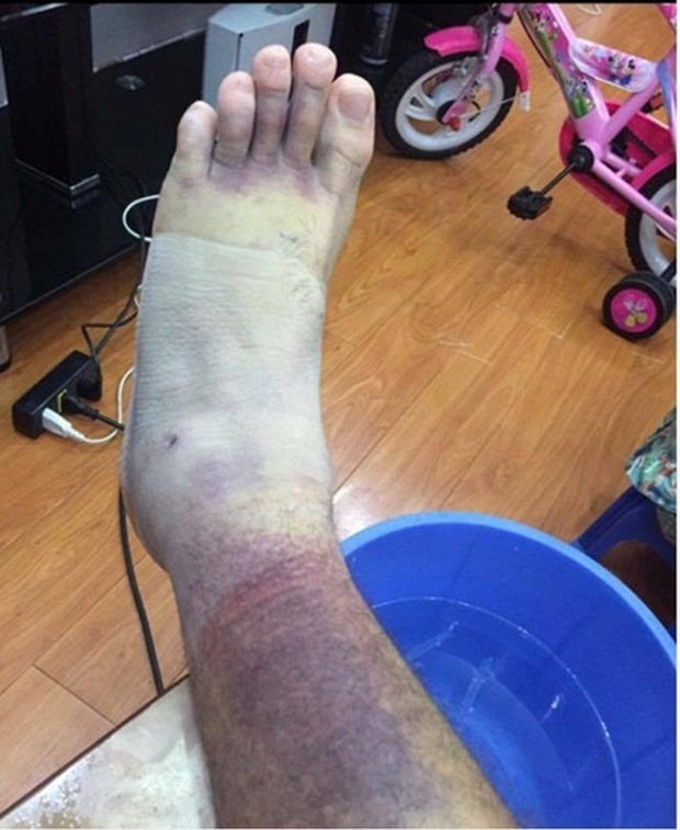Thủ môn Việt kiều Lâm Tây lộ ảnh chân bầm tím khủng khiếp sau vụ bị hành hung - Ảnh 1.