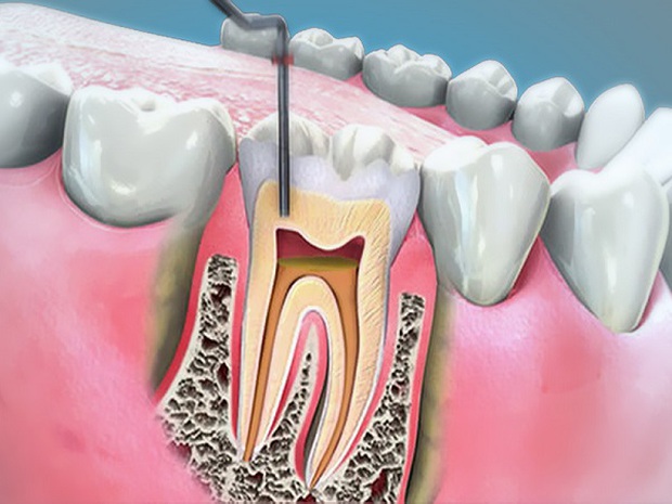 Dưới 16 tuổi, buồng tủy trong răng vẫn chưa thật ổn định