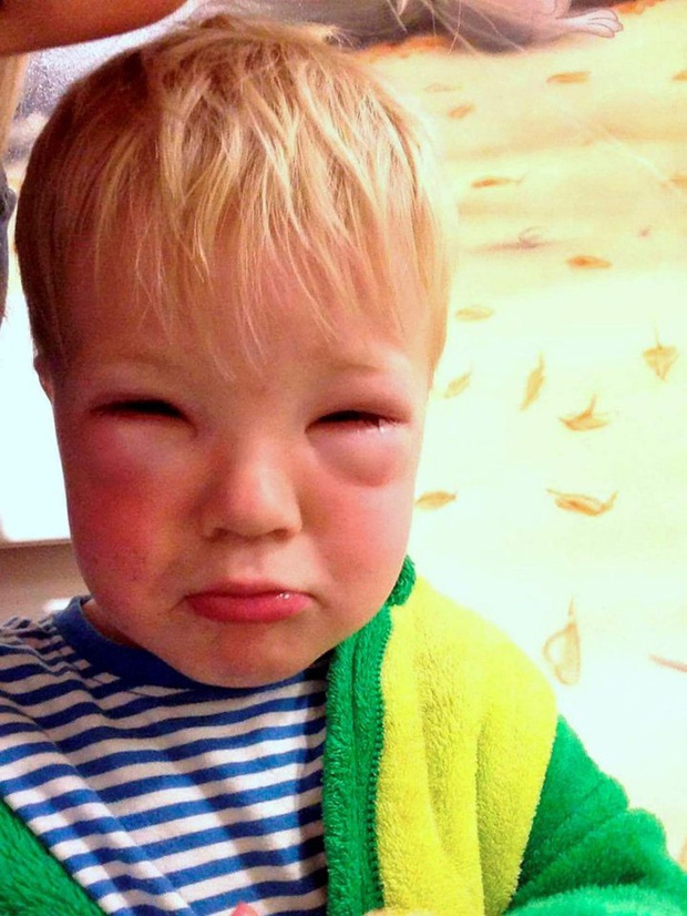 Bé trai 2 tuổi bị mù tạm thời vì mẹ nhuộm tóc - Ảnh 2.