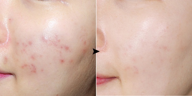 Cô nàng này đã dùng thử gel dán mụn thần thánh suốt thời gian qua và đây là kết quả - Ảnh 2. Cô nàng này đã dùng thử gel dán mụn thần thánh suốt thời gian qua và đây là kết quả - Ảnh 2.