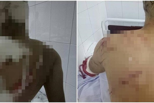 Nạn nhân bị chém tại bệnh viện.
