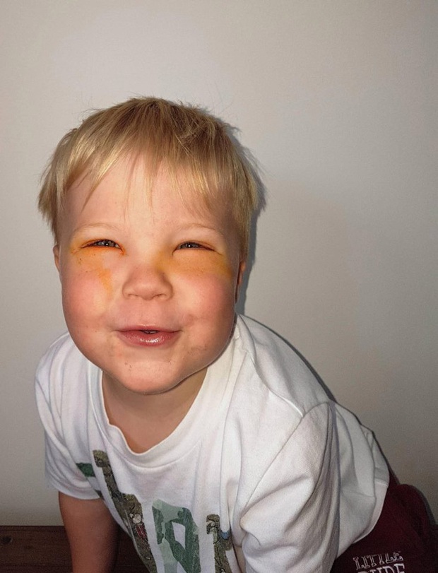 Bé trai 2 tuổi bị mù tạm thời vì mẹ nhuộm tóc - Ảnh 3.
