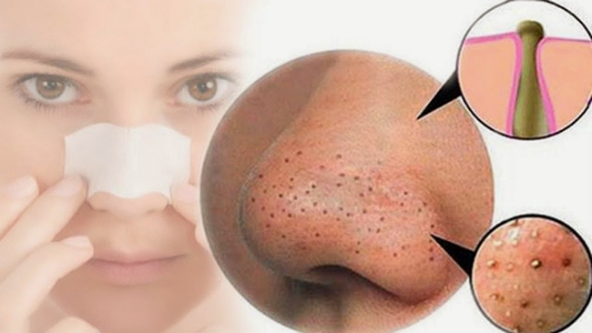 Những kiểu nặn mụn có thể gây nguy hiểm đến tính mạng - Ảnh 5. Những kiểu nặn mụn có thể gây nguy hiểm đến tính mạng - Ảnh 5.