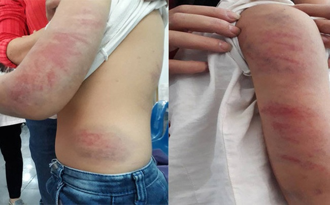 Bố say rượu liên tục đánh, đạp vào bụng con gái 9 tuổi ở Vĩnh Phúc - Ảnh 1. Bố say rượu liên tục đánh, đạp vào bụng con gái 9 tuổi ở Vĩnh Phúc - Ảnh 1.