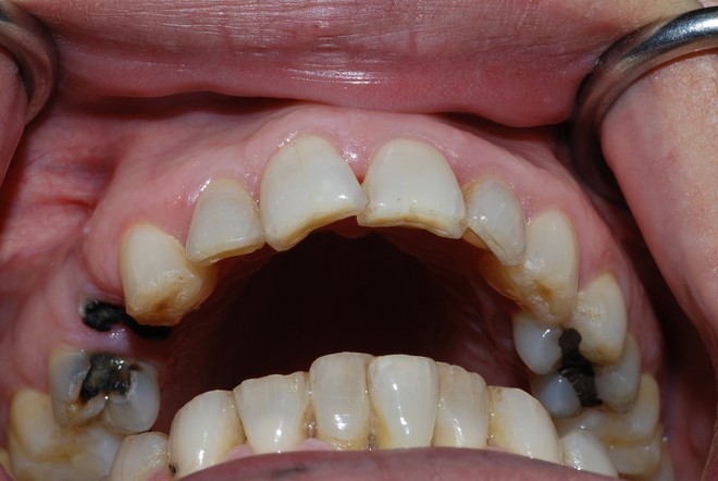 Chủ quan với chiếc răng sâu, chàng trai 26 tuổi đã ra đi mãi mãi - Ảnh 4. Chủ quan với chiếc răng sâu, chàng trai 26 tuổi đã ra đi mãi mãi - Ảnh 4.
