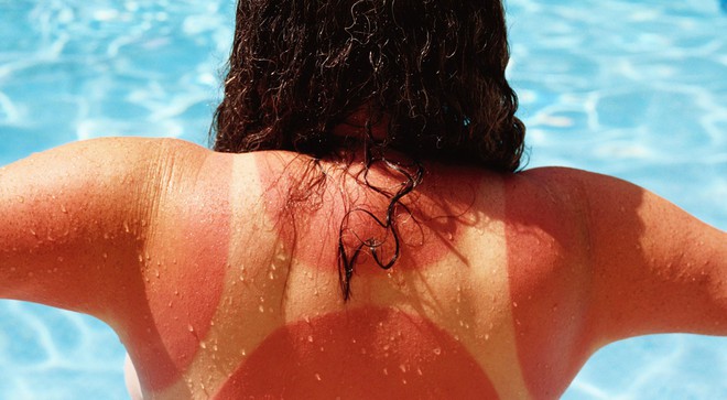 Khi bị cháy nắng, đừng làm những việc này nếu không muốn làn da của bạn bị hư hại thêm - Ảnh 3.