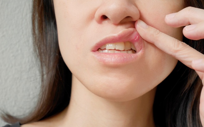 4 dấu hiệu loét miệng ngầm cảnh báo bệnh ung thư miệng đang âm thầm phát triển - Ảnh 3.