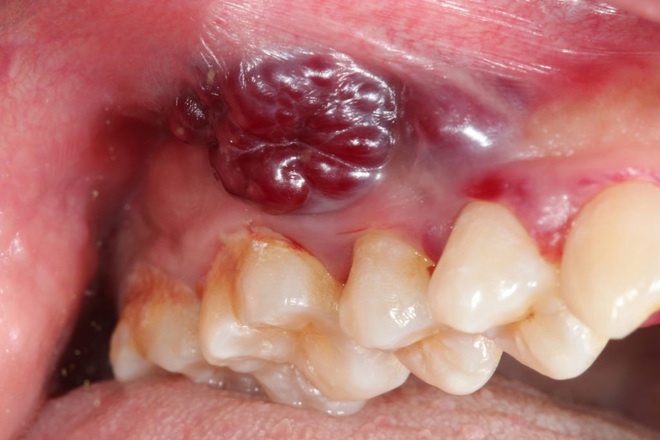 4 dấu hiệu loét miệng ngầm cảnh báo bệnh ung thư miệng đang âm thầm phát triển - Ảnh 4.