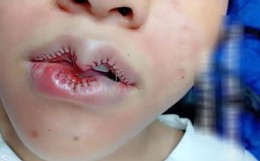 Đôi môi "trái tim yêu dấu" nổi tiếng nhất MXH đêm qua, chủ spa hạnh phúc khoe thành quả, dân mạng ném đá "chẳng khác mỏ chim"