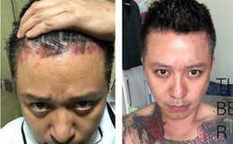 Tất cả những điều cần biết để phòng tránh căn bệnh quái ác mà ca sĩ Tuấn Hưng đang mắc phải