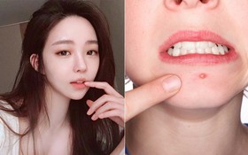 7 sản phẩm chiết suất tràm trà công dụng từ làm sạch đến dưỡng ẩm, trị tận gốc những vết mụn cứng đầu