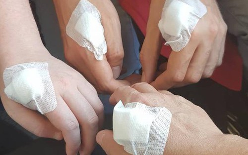 Cận cảnh đôi bàn tay cấy chip của người Thụy Điển, thay thế cho hàng tá loại thẻ rắc rối