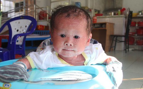 Phép màu kỳ diệu đã đến với bé gái 14 tháng tuổi người đầy vẩy ngứa như da trăn