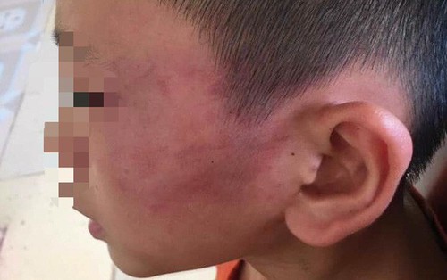 Bé trai 12 tuổi nghi bị mẹ kế bạo hành ở Nghệ An vẫn chưa hết sợ hãi khi nhắc tới chuyện về nhà