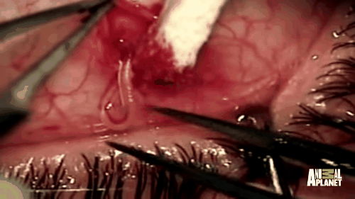 Giun b&ograve; ngọ nguậy trong mắt v&agrave; nguy&ecirc;n nh&acirc;n khiến bạn ng&atilde; ngửa - Ảnh 3.