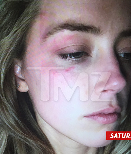 Amber Heard tung ảnh bầm mắt, tố Johnny Depp bạo hành mình - Ảnh 1.