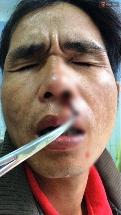 Kinh hoàng phát hiện đỉa dài hơn 5 cm trong mũi người đàn ông - Ảnh 1.
