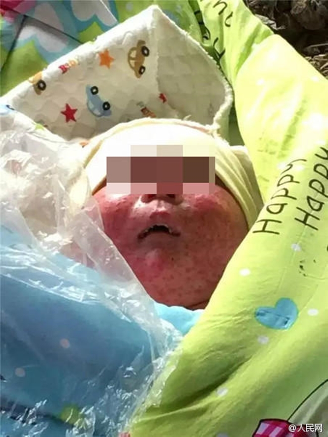 Gương mặt chi chít vết thương vì côn trùng cắn của đứa trẻ bị bỏ rơi dưới gầm cầu - Ảnh 1.