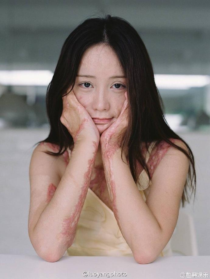 Bộ ảnh tuyệt đẹp của c&ocirc; g&aacute;i xinh đẹp bị bạn học tẩm xăng đốt v&igrave; m&acirc;u thuẫn  t&igrave;nh cảm