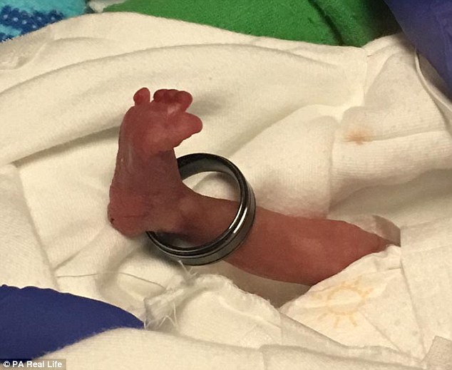 Sức sống kỳ diệu của em bé sinh non 21 tuần tuổi nặng có 400g, bàn chân lọt thỏm trong chiếc nhẫn - Ảnh 1.