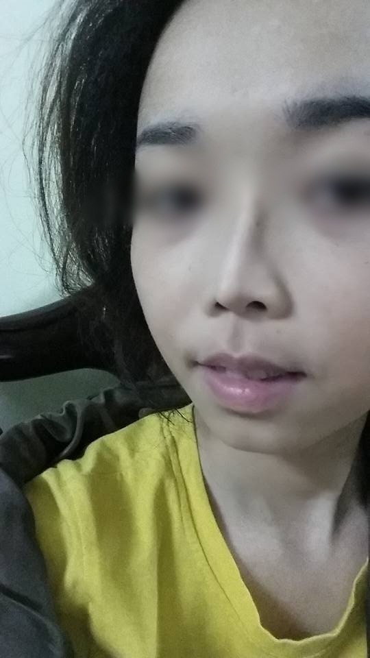 Cô gái Hà Nội bế tắc vì đã 2 lần đau đớn PTTM nhưng mũi vẫn... lệch - Ảnh 4.