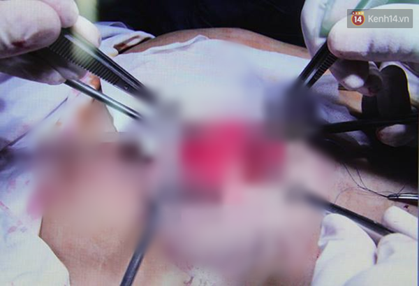 Tiêm silicon dạo, một phụ nữ bị hỏng cả ngực và mặt - Ảnh 2.