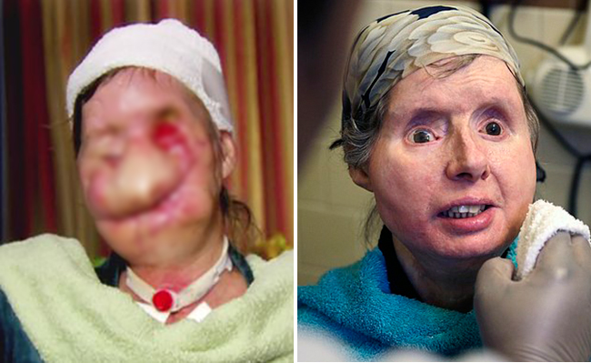 Dung mạo thay đổi kinh ngạc của người phụ nữ bị tinh tinh cào rách mặt - Ảnh 2.