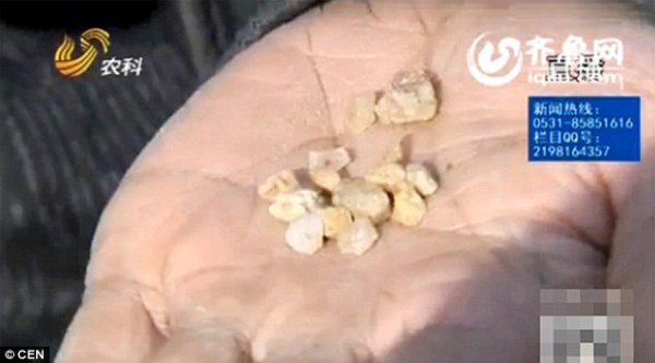 Người phụ nữ Trung Quốc kh&oacute;c ra... sỏi đ&aacute; - Ảnh 2.
