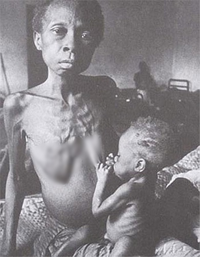 Chùm ảnh những đứa trẻ châu Phi gầy trơ xương vì đói sẽ khiến bạn không dám bỏ thừa đồ ăn thêm nữa - Ảnh 16.