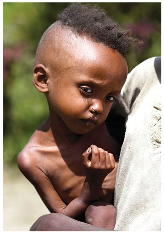 Chùm ảnh những đứa trẻ châu Phi gầy trơ xương vì đói sẽ khiến bạn không dám bỏ thừa đồ ăn thêm nữa - Ảnh 21.